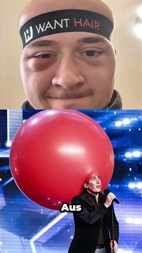 Tag 5 nach der Haartransplantation. So sieht mein Kopf aus #beforeandafter #trending