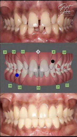 Teeth Gaps Treatment with Dental Clear Aligners and Artificial Teeth - #invisalign #dentalbridge