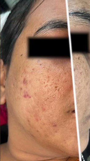 2 Sessions of Microneedling + Face PRP | Real Skin Transformation
