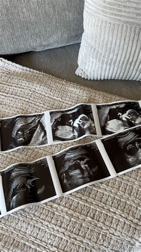 Joann, RDMS (OB/GYN, AB), RVT on Instagram: "My baby’s ultrasound vs. me in utero. Ultrasound machines have evolved so much through the years and the level of detail has greatly improved. But I wanna know what kind of machine was scanning me back then 😂 #ultrasound #ultrasoundtech #sonographer #sonography #anatomyscan"