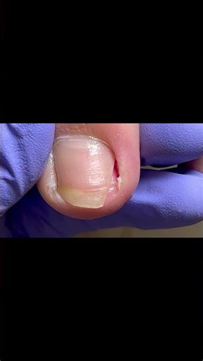 To Treat Paronychia, Dig A Large Hole.