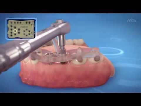 MGuide More / Guía de procedimiento quirúrgico - MIS Implants