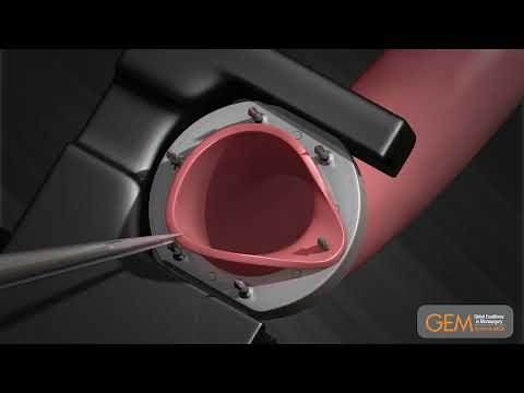 Microvascular Anastomotic GEM COUPLER Device Instructions for Use
