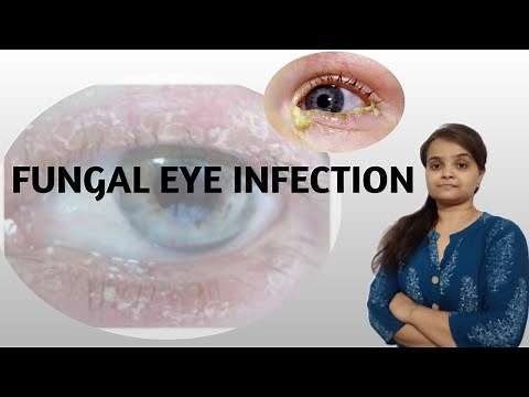 FUNGAL EYE INFECTION