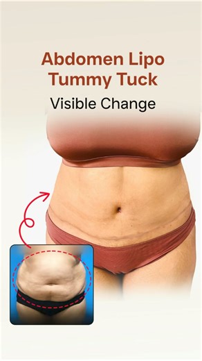 Tummy Tuck and Abdomen Liposuction Before and After #shortsfeed
