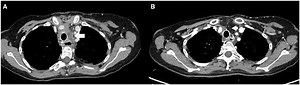 Mediastinitis after a cryopreserved allograft tracheal transplant treated by transposition of the major omentum