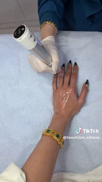 استعيدي نضارة يديك مع الدرما RF