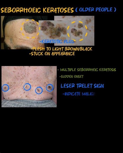 Seborrheic keratoses and Leser- trelet sign - Dermatology