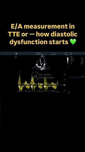 #diastolic dysfunction in #echocardiography - E/A measurement