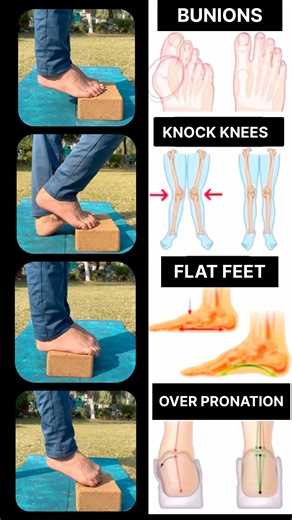 #footpainrelief #footpainrelief #flatfoot #heelpainrelief #overpronation #flatfeet #flatfoot