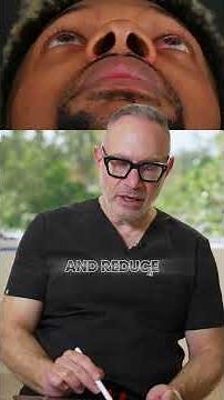 Alar Base Reduction to Change Nostril Shape