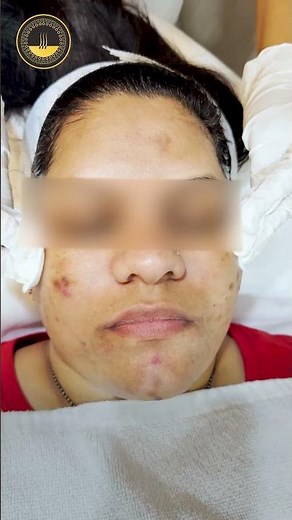 Say Goodbye to Acne Dark Spots! 🚫 | Advanced Laser & Peel Treatment