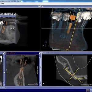 Implant solution for a narrow ridge # 43 replacement 1. Complete digital workflow: Cerec SW4.4 XG3d CBCT scan(30 min) 2. Design inhouse cerec 2 surgical guide (90Min) 3. Place narrow roxolid straumann implant fixture with Densah drill protocol ( 20 min)- NO grafting required 4. ISQ: Get osstell reading >75 5.Utilize scan body to fabricate screw retained E-Max restoration on a T-Base (90 min) with SW 4.4 | Woodbury Dental and Laser Clinic