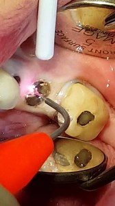 Watch the amazing Picasso Lite trimming tissue off the healing cap of an implant recovery! No sparks, no blood, and totally safe! Thanks Dr. Ron Kaminer! Check out the Picasso Lite today: http://www.amdlasers.com/?pages=liteplus | AMD LASERS