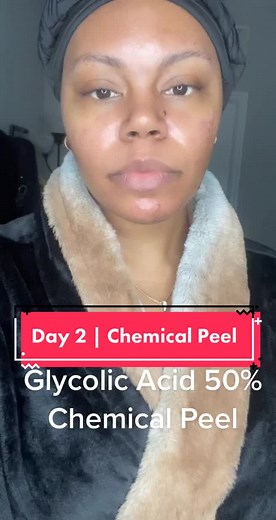 Day 2 Chemical Peel Journey | Glycolic Acid 50% Peel Process