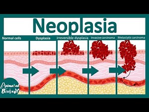 Neoplasia | pathology underlying neoplasia | USMLE