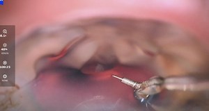 Interventional Glaucoma Case: iDose and iStent Infinite - Eyetube
