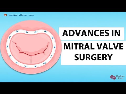 Mitral Valve Surgery: Advances in Minimally-Invasive & Transcatheter Procedures with Dr. Chikwe