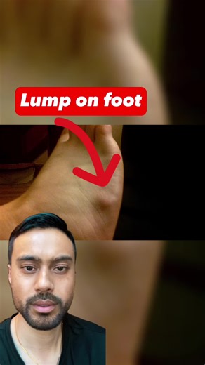 This lump on the foot is called a ganglion cyst. #fyp #viral #cystpopping #podiatry #podiatrist #dermatologist