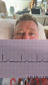 15K views · 216 reactions | What is a PAC? #cardiac #rhythminterpretation #ekg #ecg #fyp #ECT4Health #nursesoftiktok #paramedicsoftiktok #nurseeducation #paramediceducation | ECT4Health- Nurse/Paramedic Education | Facebook