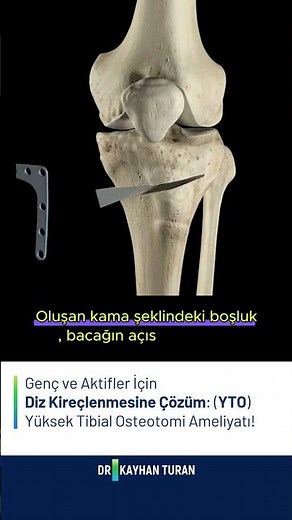 Yüksek Tibial Osteotomi