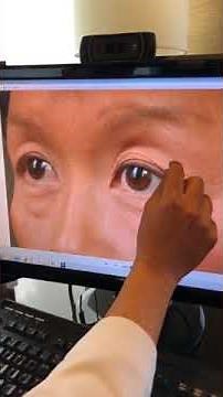 Lower Eyelid Blepharoplasty with Fat Repositioning Explained by Kami Parsa M.D. Beverly Hills CA