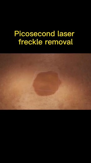 2.6K views · 20 reactions | #Picosecond #laser #freckle #foryou #fypage | Sience | Facebook