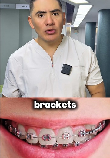 Brackets: ¿Realmente mueven los dientes?