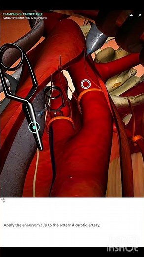 "Carotid Endarterectomy | Stroke Prevention Surgery Explained"