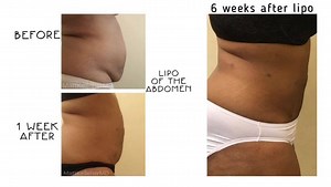 Liposculpture : Precise, exact, thorough, easy and safe body contouring to help with stubborn fat in problem areas. #lipo | Premier Dermatology | Facebook