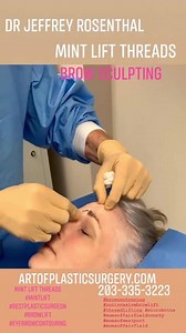 Brow lift with ‘Mint Lift Threads’.