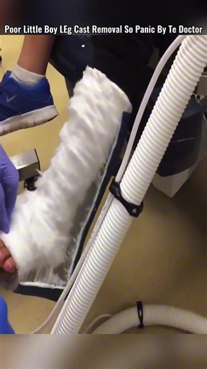 Poor Little Boy Leg Cast Removal So Panic By The Doctor 😱 #castremoval #cutting #brokenleg #help #removal