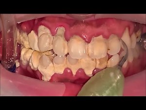 Tartar Removal - Scaling • Video • MEDtube.net