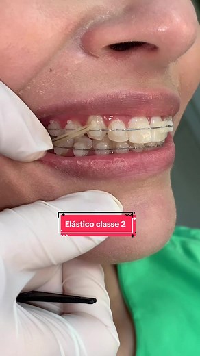 Como Colocar Essência no Pod ElfBar: Elástico Classe 2 e Aparelho de Dente