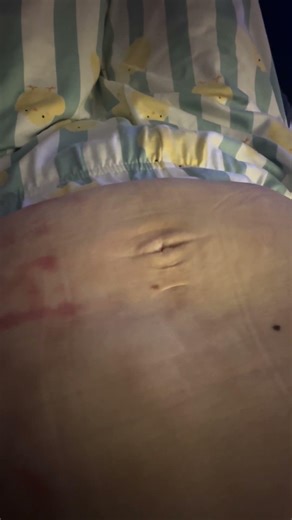 Here’s what having a structure due to Crohn’s Disease looks like.