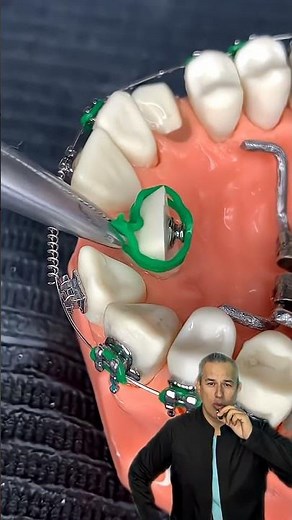 🔥Combination of ORTHODONTIC Forces (Button, Brackets, Chains)🔥