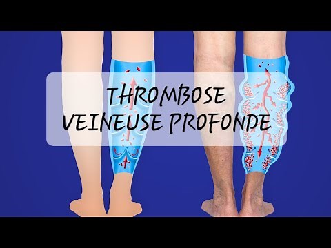 DVT: Deep vein thrombosis!