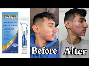 My 6 month Expirience with Differin Gel Adapalene | My Acne Journey