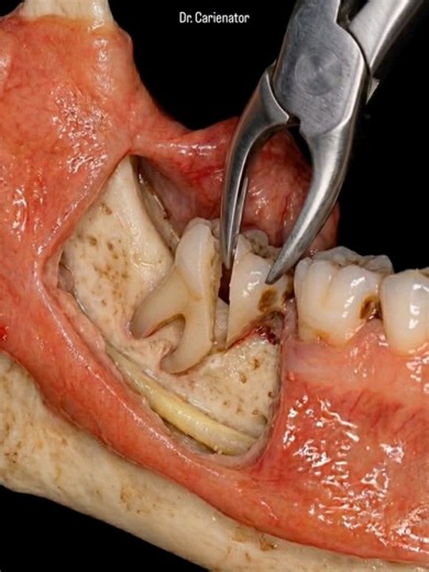 Witness the precise process of a dental extraction! 🦷 This detailed animation shows how dentists make an incision, section the tooth for easier removal, and complete the procedure. Informative and fascinating. #oralhealth #toothextraction #wisdomtooth #OralCare #dental