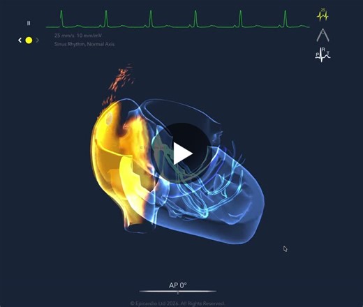 #claude #cardiology #pacemaker #electrophysiology #heartrhythm #medicaleducation #medicalexcellence #cathlab #healthcareprofessionals #innovationinmedicine #cardiacscience #medtech #meded | Epicardio