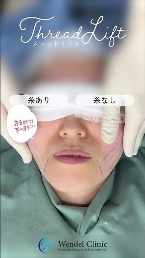 15秒でわかる、スレッドリフトの効果 #美容整形 #スレッドリフト #糸リフト #美容