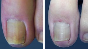 Nashville Podiatrists: The Nashville Foot and Ankle Group: Laser Treatment for Toenail Fungus: GenesisPlus and PinPointe Laser Treatment