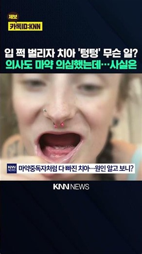 Even the doctor suspected drug addiction… The 'unexpected cause' of losing all teeth / KNN
