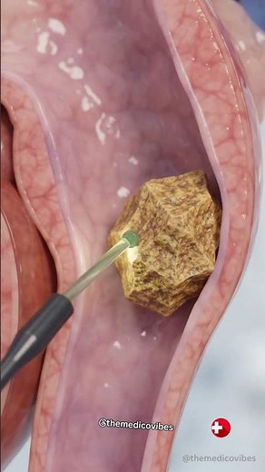 🩺 KIDNEY STONE REMOVAL SURGERY