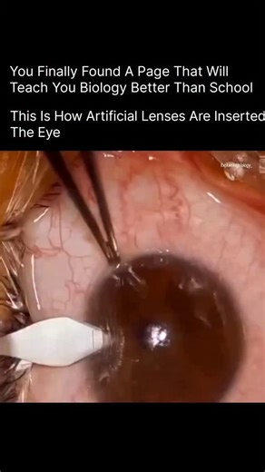 BIOLOGY | MEDICAL | HEALTH on Instagram: "During cataract surgery, the cloudy natural lens of the eye is removed and replaced with a clear artificial lens, called an Intraocular Lens (IOL). First, the surgeon makes a tiny incision in the cornea. Using ultrasound waves (phacoemulsification), the cloudy lens is broken into small pieces and gently removed. Then, the foldable artificial lens is inserted through the same small cut. Once inside, it unfolds and settles perfectly in the natural lens pos