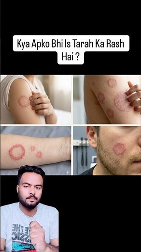 Ringworm: It’s Not a Worm! | Fungal Skin Infection Explained