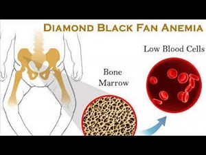 Diamond Black fan Anaemia / Black fan Diamond Anaemia ; Causes, Symptoms and Treatment
