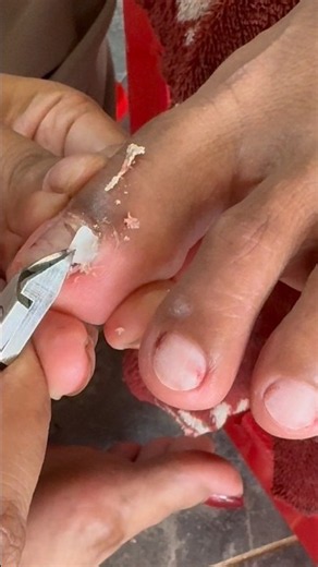 Insane Ingrown Toenail Removal Process!🦶✨ #satisfying #pedicure #toenails #nailcare #shorts