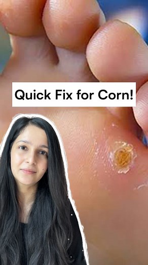 Dr. Su on Instagram: "Product Recommendations for Corn🦶 (NOT SPONSORED) 1)Corn Caps🩹 -Leeford Cornex Caps -Medigrip Corn Caps -Dr.Foot Corn Caps (To be changed every 48 hours.Use it atleast for 2 weeks) 2)Topical Salicylic Acid -Salactin Paint -Salex-L Solution •ProTip:- Soak the affected area in warm water for 10-20 mins. Use Pumice Stone to remove the top dead layer of skin(to be done with exteeme care in diabetics). Pat dry. Apply vaseline around your corn and ON it apply salicylic acid. Le