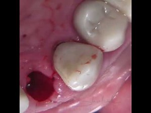 Benex extraction system